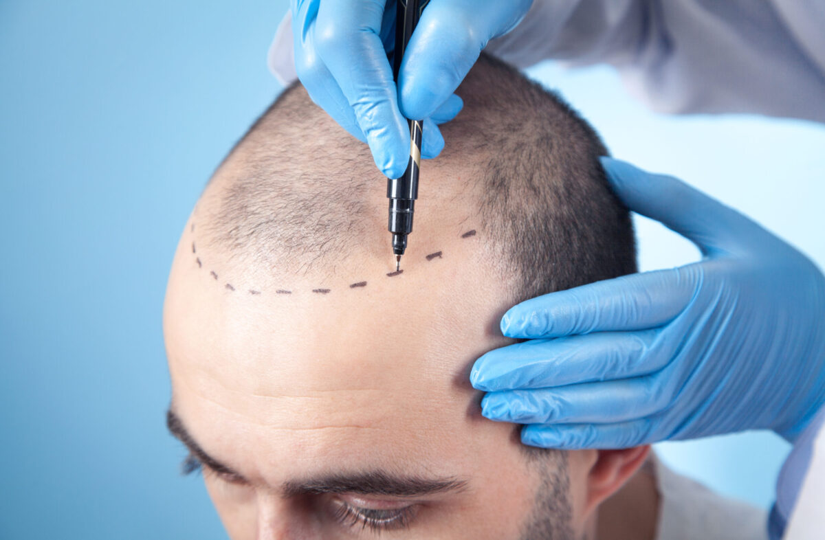 Hair Transplant Surgeon