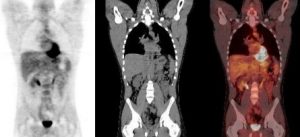 Nuclear Medicine